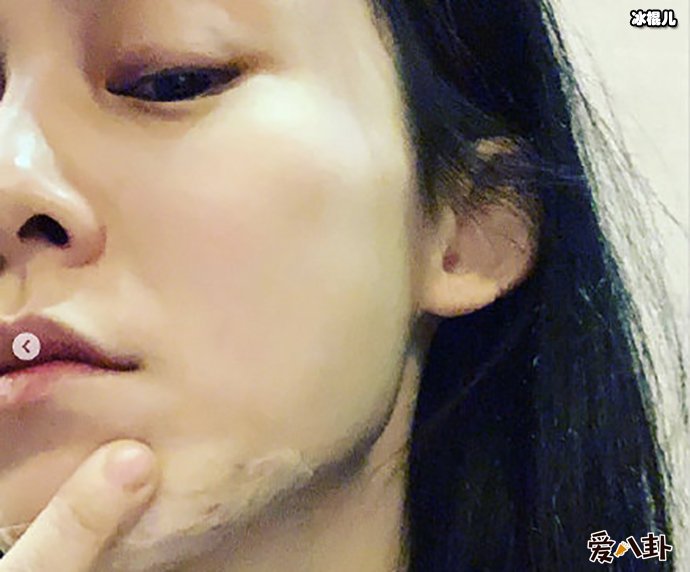 范玮琪发生了什么下巴缝15针?为何其那么遭网友嫌弃?